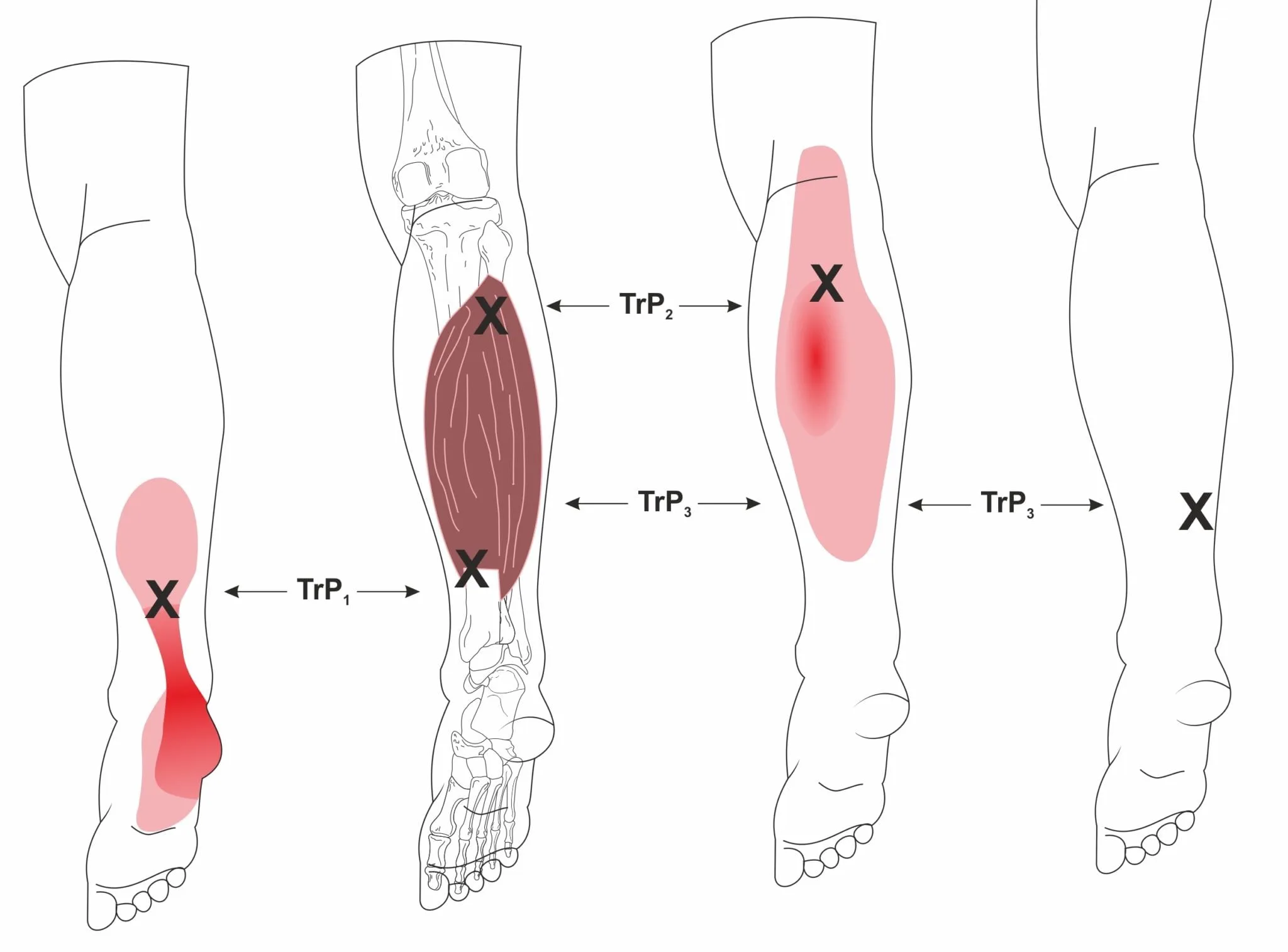 Achilles tendinopathy treatment