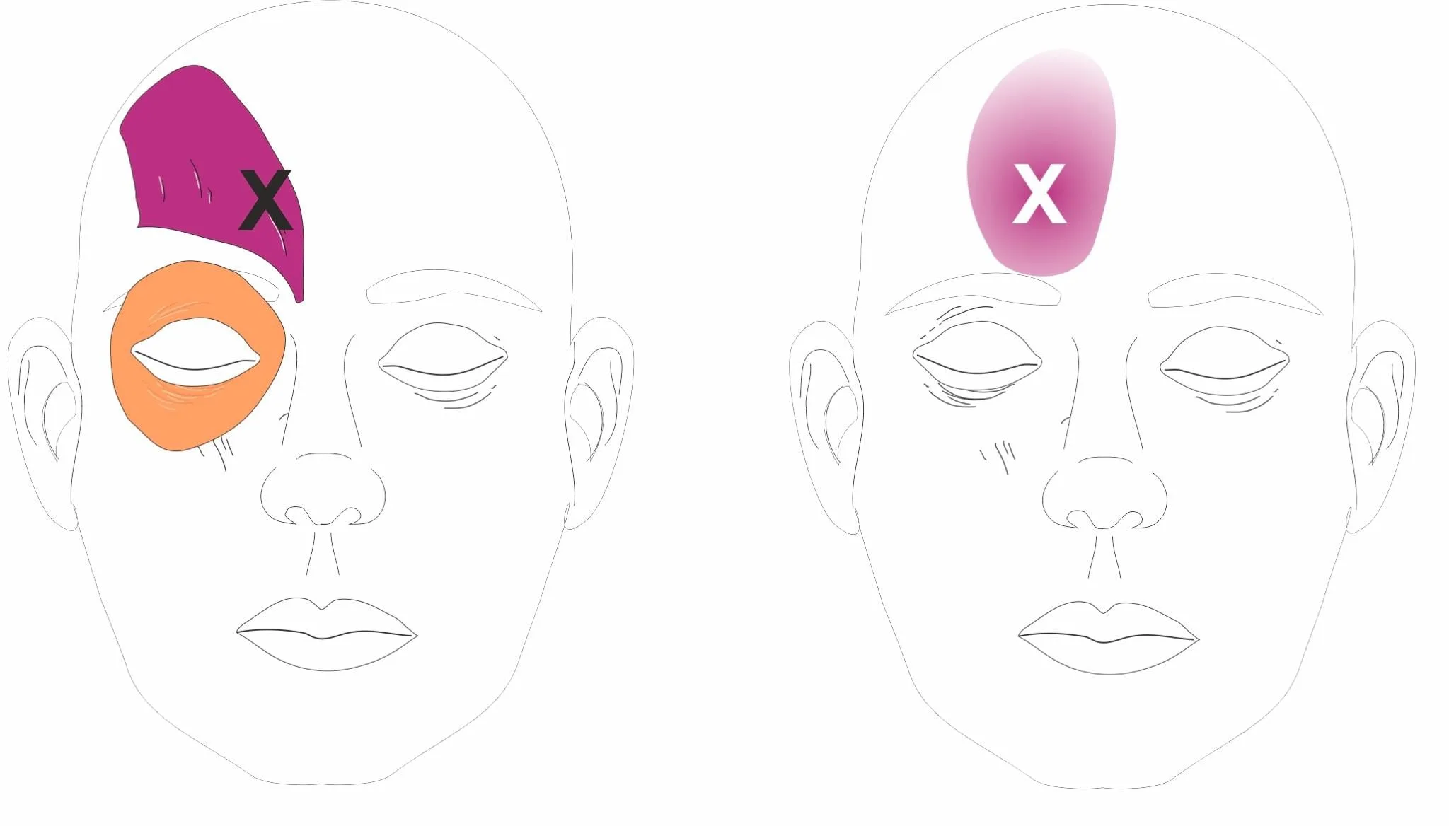 Anterior headache pain