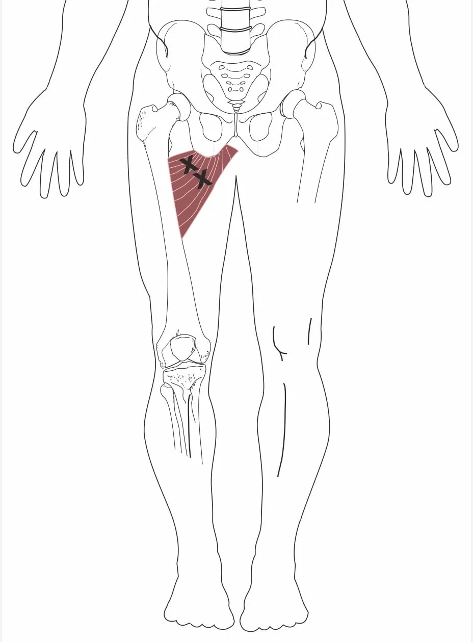 Groin strain FAI treatment