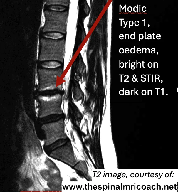 Modic Type 1 disc end plate changes on MRI
