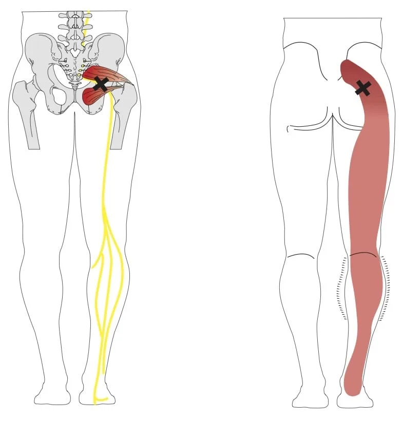 Piriformis syndrome lower spine diagram