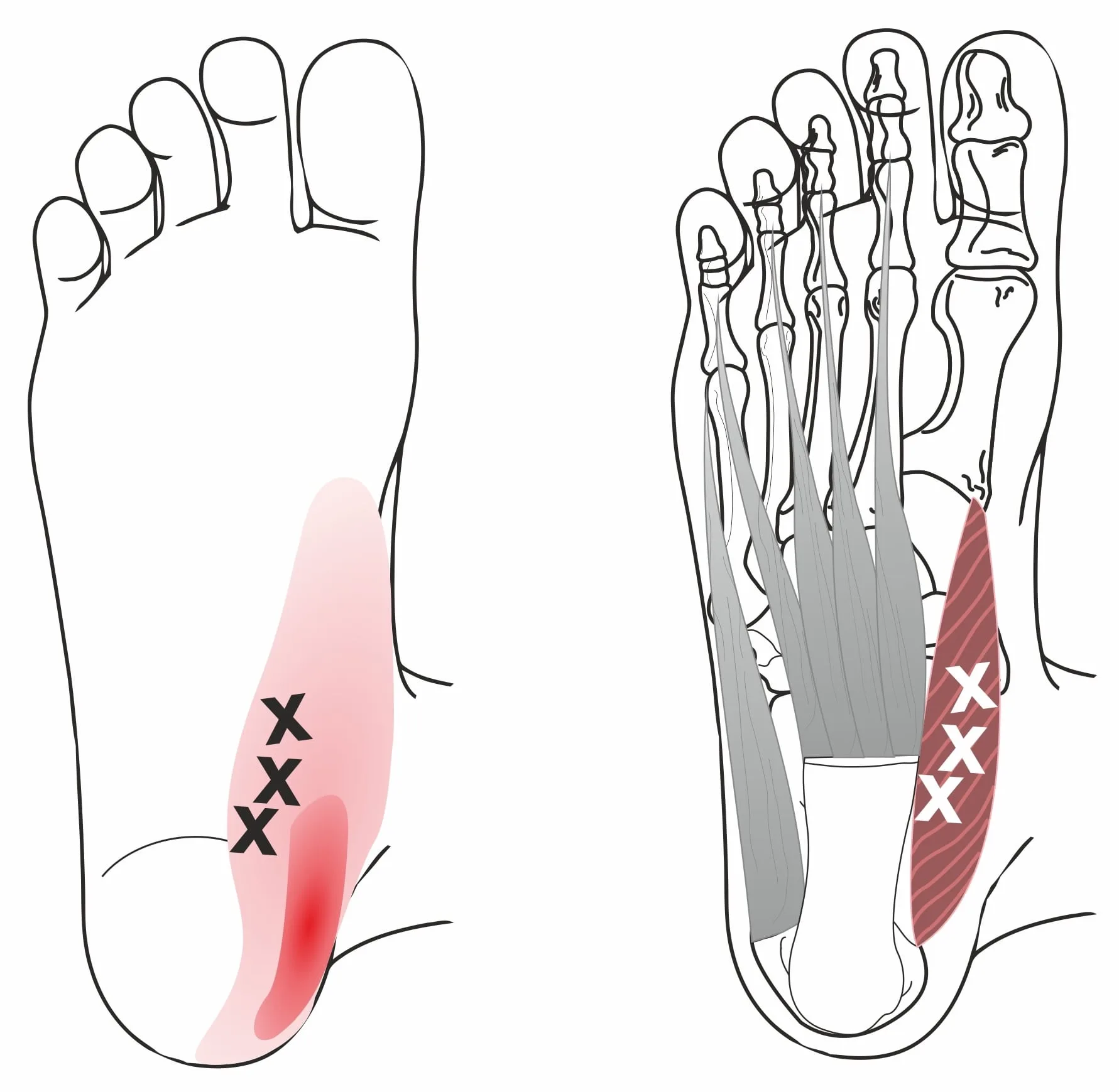 Plantar fasciitis heel pain treatment