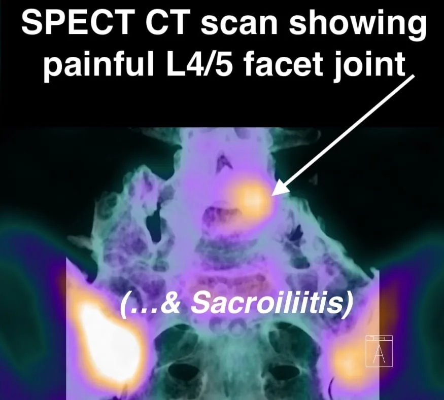 Transitional lumbosacral joints MRI