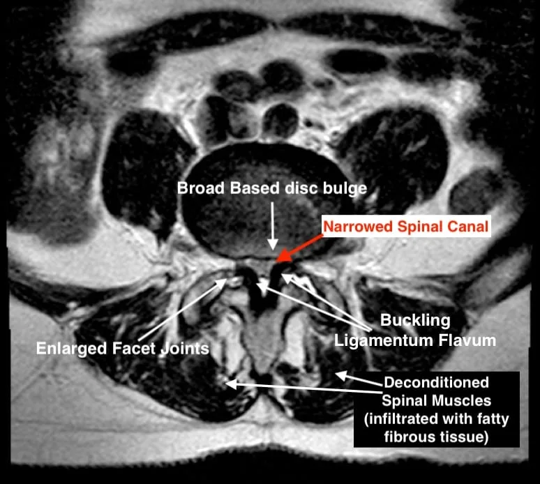 Spinal stenosis causes and treatment