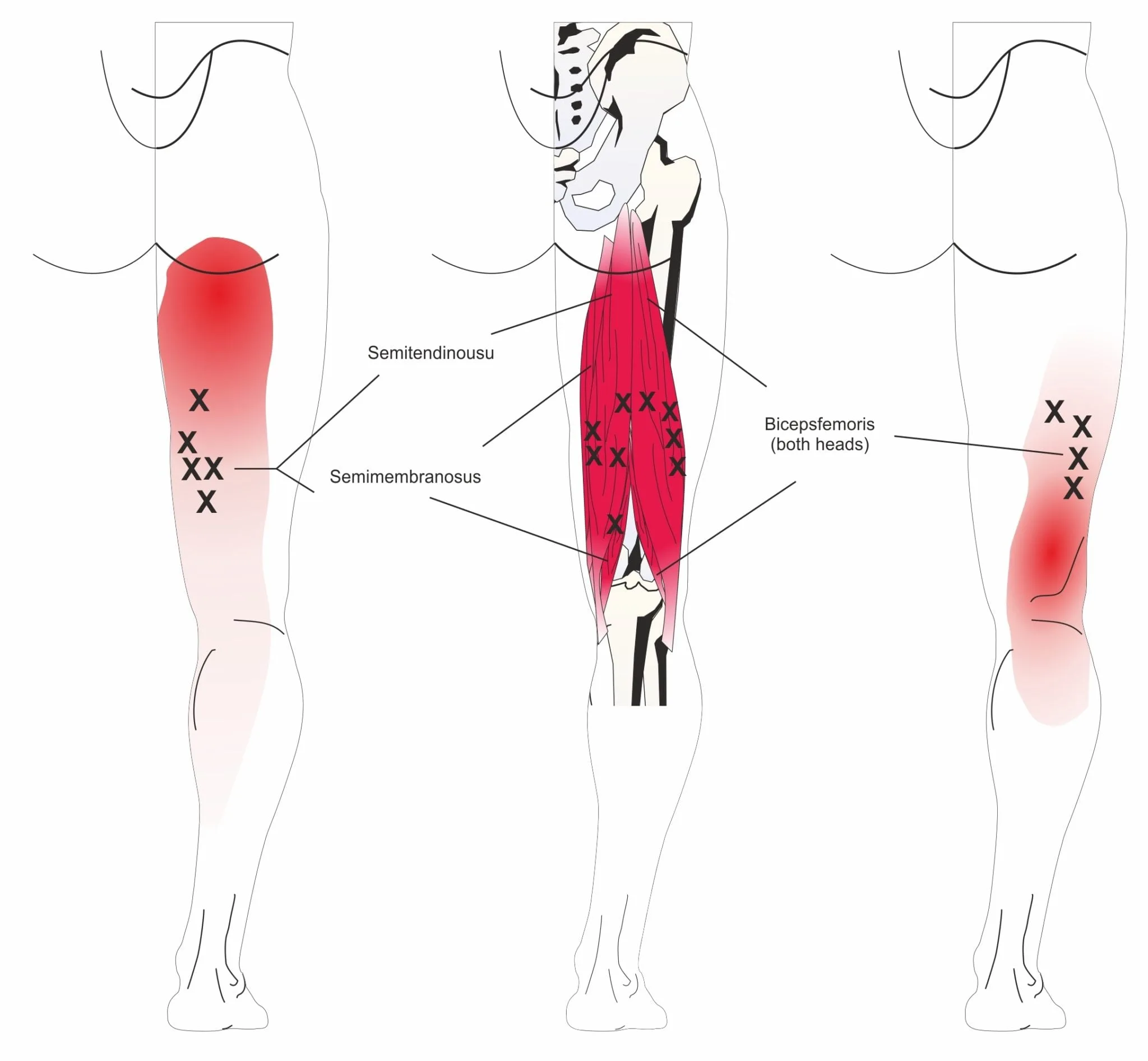Hamstring strain therapy