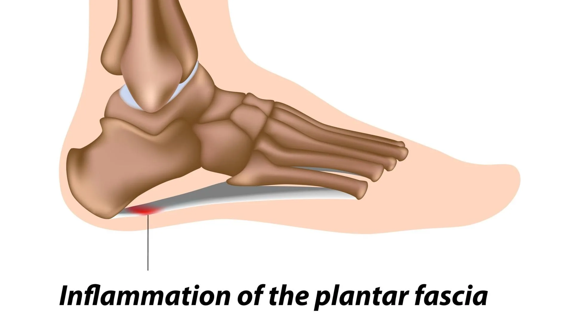 Plantar fasciitis anatomy