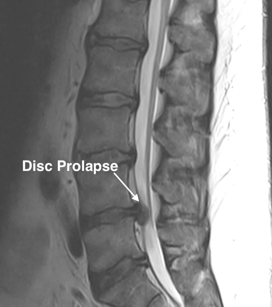 Bulging disc treatment