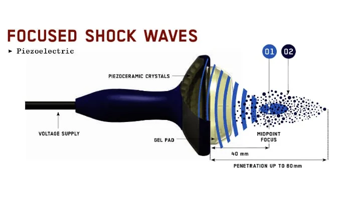 Focused Shockwave