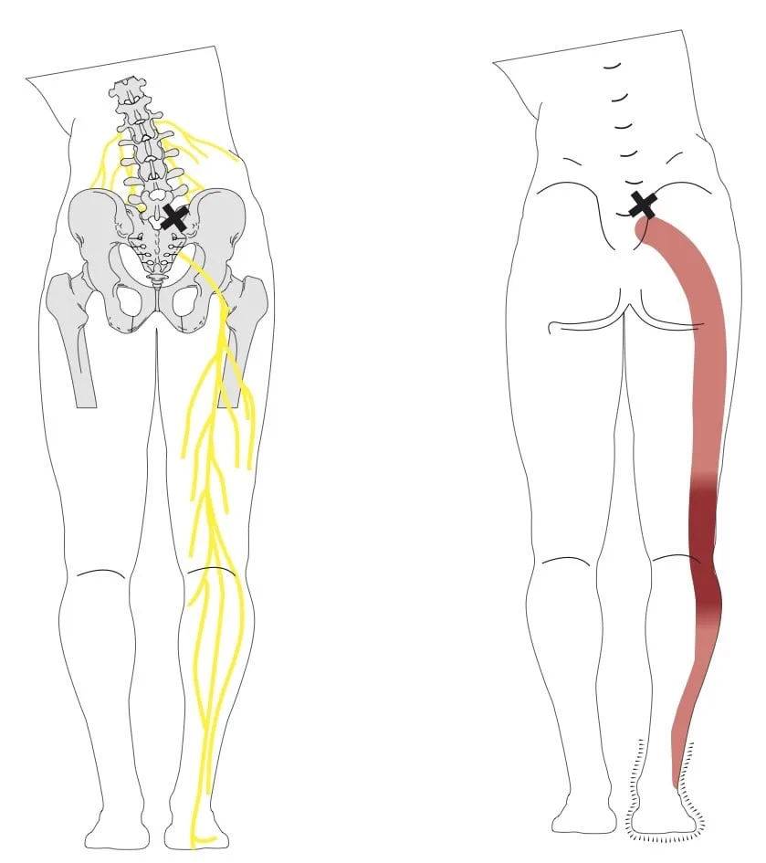 Sciatica pain from disc prolapse