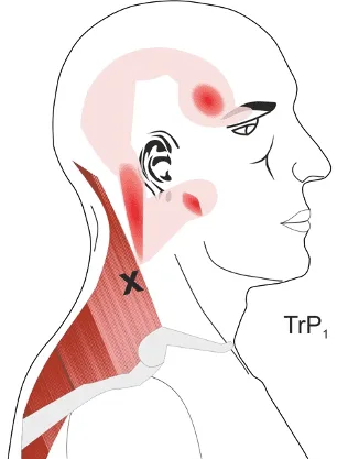 Myofascial pain trigger points trapezius