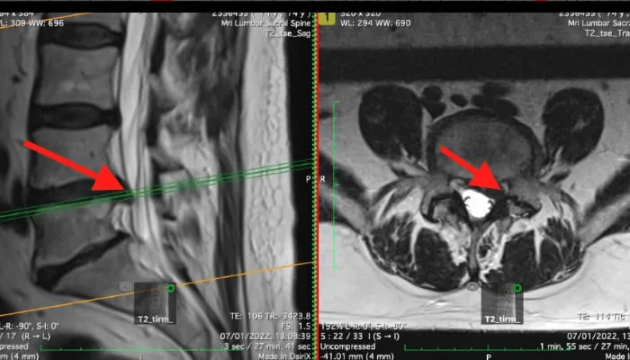 MRI of lumbar spine showing L3/4 stenosis