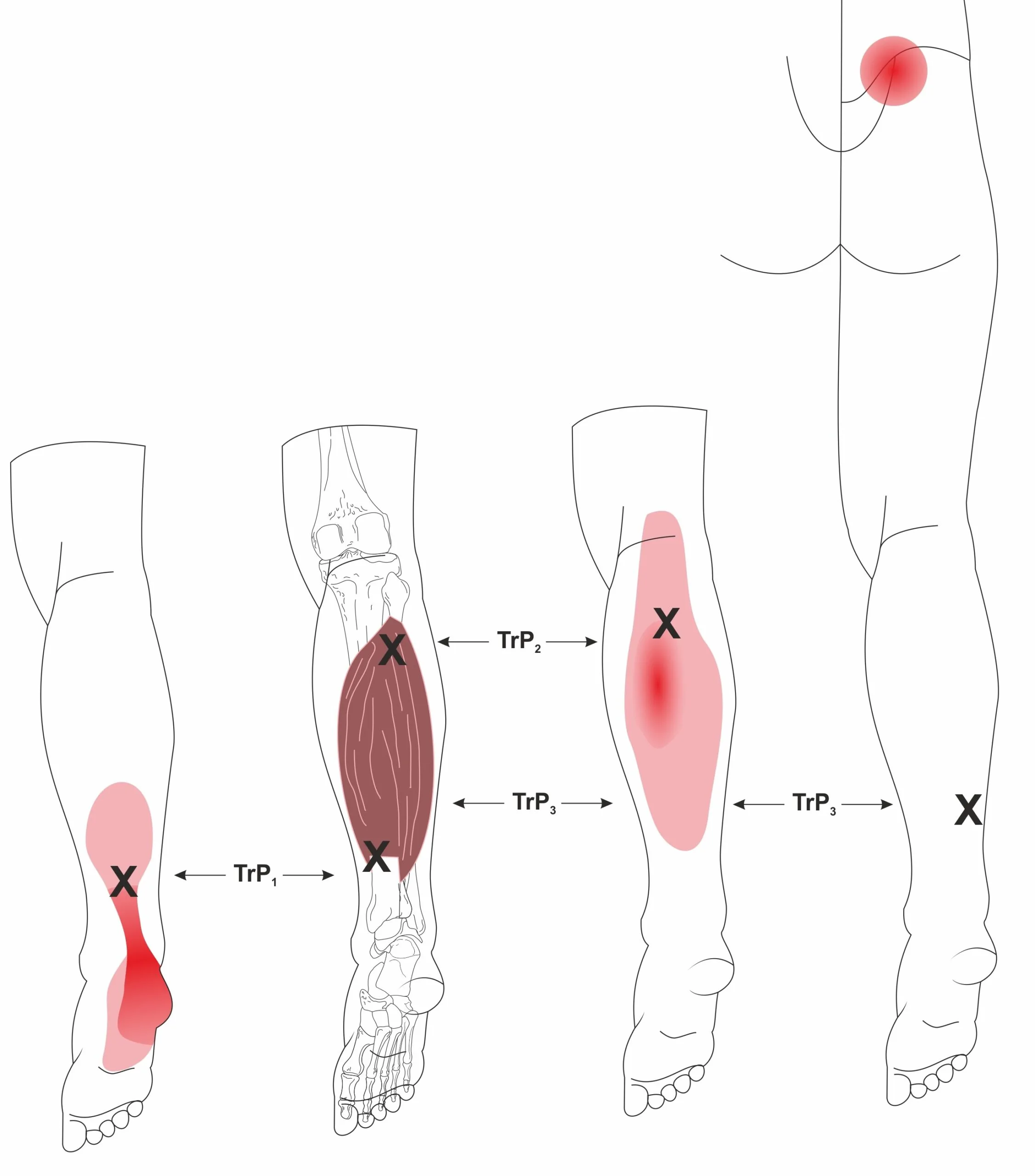 Calf and Achilles trigger points